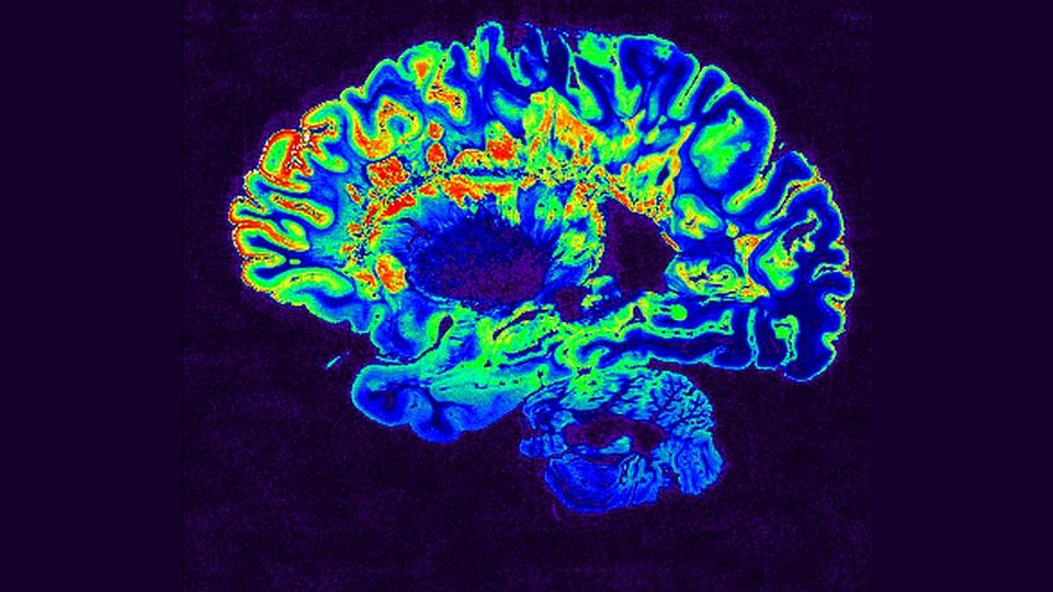 Tipping the Balance’ of Immune Cells From Bad to Good Reverses Multiple Sclerosis Symptoms in Mice
